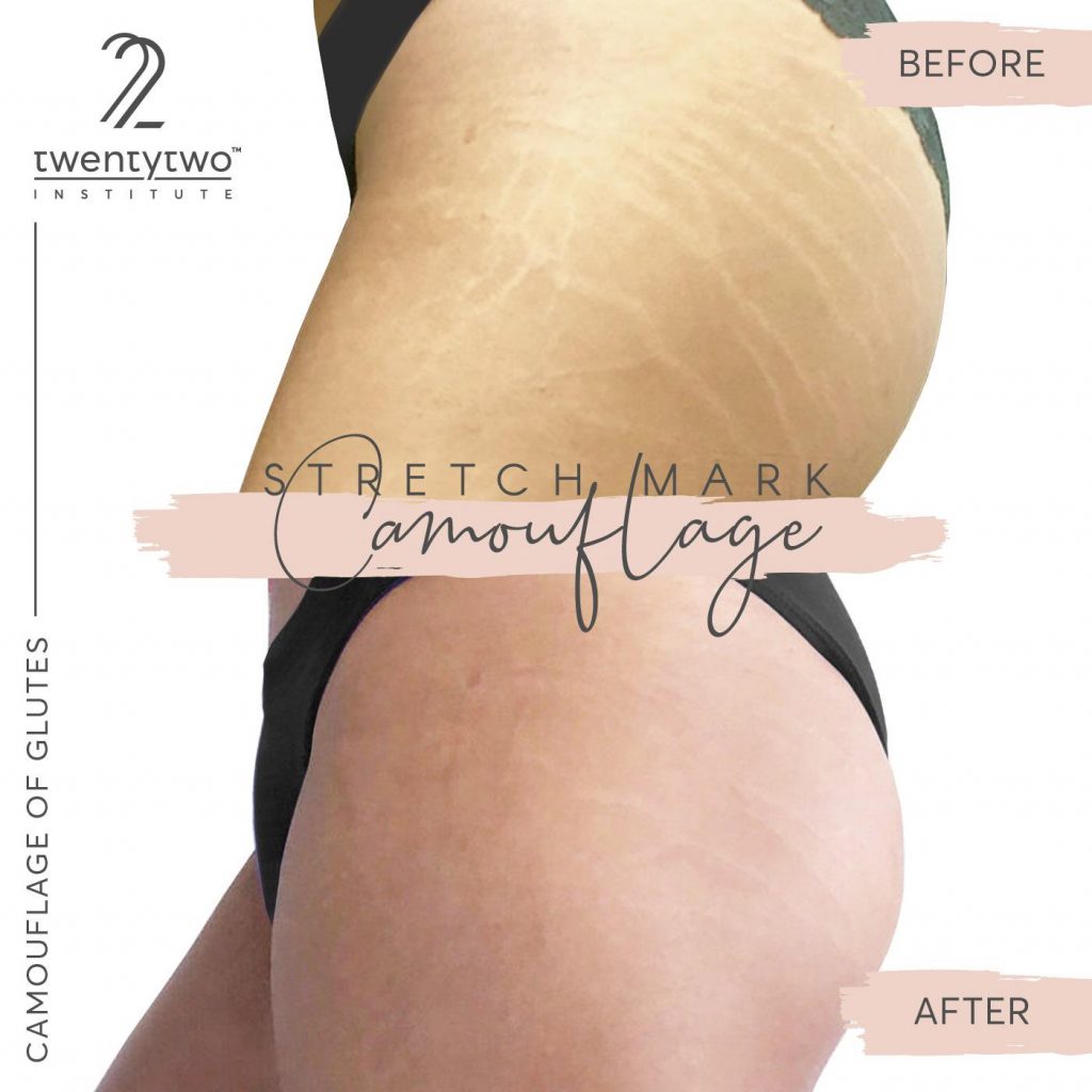 how-to-select-the-right-skin-pigment for stretch mark camouflage